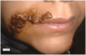 -herpes09