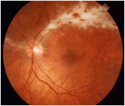 CMV retinitis