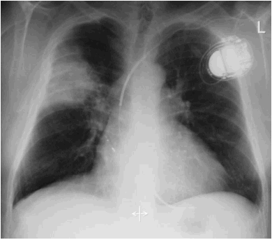 F:\NICE ENSEIGNEMENT 15 aout 2010\COLLEGE NATIONAL DES PU-PH\POLY-ECN- 18 juullet 2010\OUVRAGE_11_aout\CHAPITRES\86 INFECTIONS RESPIRATOIRES\FIGURES\figure 2.JPG