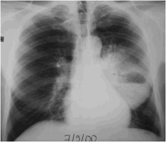 F:\NICE ENSEIGNEMENT 15 aout 2010\COLLEGE NATIONAL DES PU-PH\POLY-ECN- 18 juullet 2010\OUVRAGE_11_aout\CHAPITRES\86 INFECTIONS RESPIRATOIRES\FIGURES\figure 7.jpg