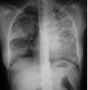 F:\NICE ENSEIGNEMENT 15 aout 2010\COLLEGE NATIONAL DES PU-PH\POLY-ECN- 18 juullet 2010\OUVRAGE_11_aout\CHAPITRES\86 INFECTIONS RESPIRATOIRES\FIGURES\figure 8.jpg