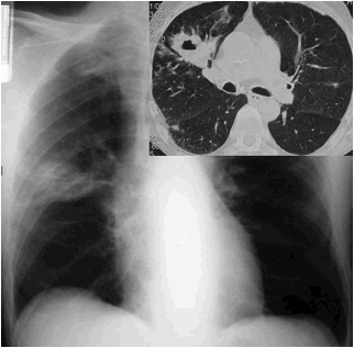 F:\NICE ENSEIGNEMENT 15 aout 2010\COLLEGE NATIONAL DES PU-PH\POLY-ECN- 18 juullet 2010\OUVRAGE_11_aout\CHAPITRES\86 INFECTIONS RESPIRATOIRES\FIGURES\figure 11.JPG