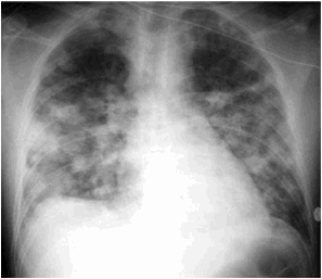 F:\NICE ENSEIGNEMENT 15 aout 2010\COLLEGE NATIONAL DES PU-PH\POLY-ECN- 18 juullet 2010\OUVRAGE_11_aout\CHAPITRES\86 INFECTIONS RESPIRATOIRES\FIGURES\figure 9.JPG