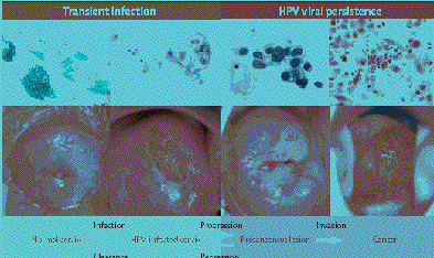 papillomavirus niveau 3