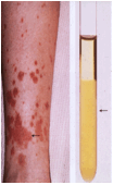 purpura + cryo tube