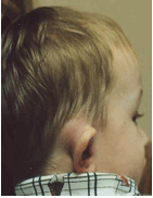 lateral_child_coallescent_mastoiditis